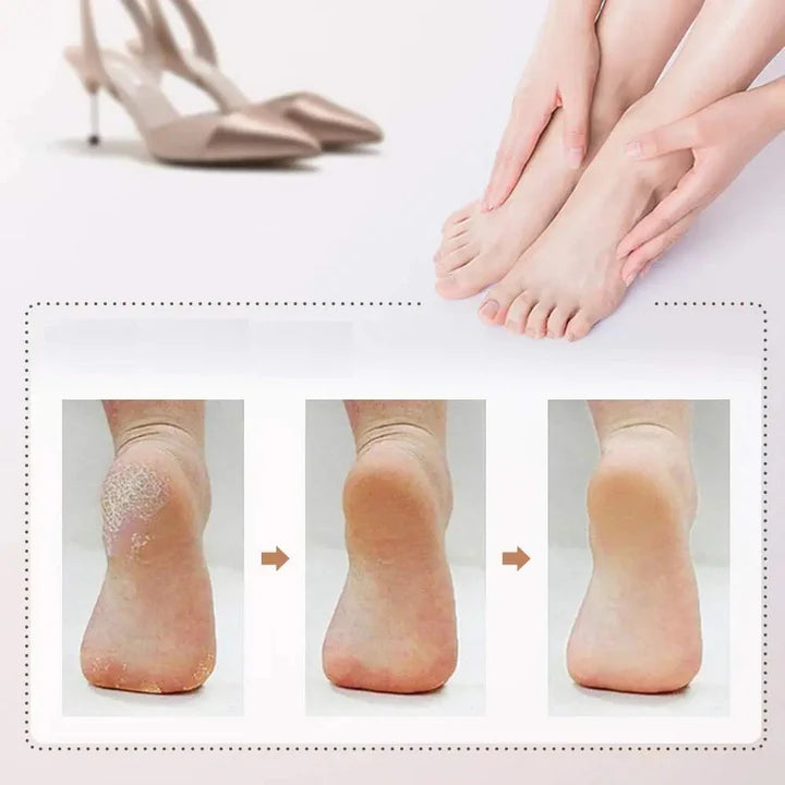 Removedor de Callos Portátil SuaviFeet™ – Talones suaves como nuevos sin salir de la casa